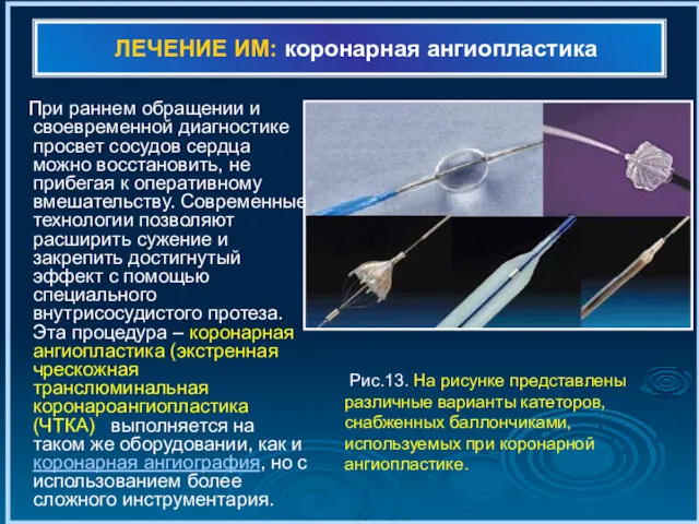 ЛЕЧЕНИЕ ИМ: коронарная ангиопластика При раннем обращении и своевременной диагностике