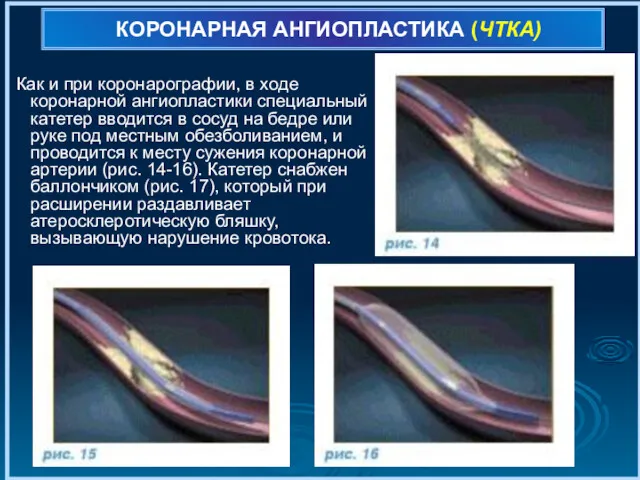 КОРОНАРНАЯ АНГИОПЛАСТИКА (ЧТКА) Как и при коронарографии, в ходе коронарной