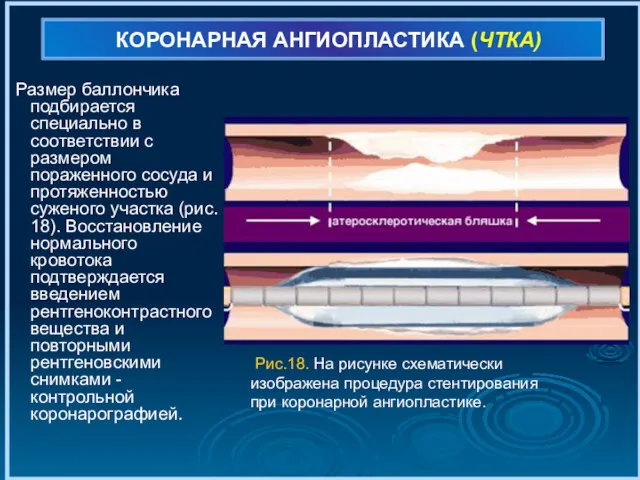 КОРОНАРНАЯ АНГИОПЛАСТИКА (ЧТКА) Размер баллончика подбирается специально в соответствии с