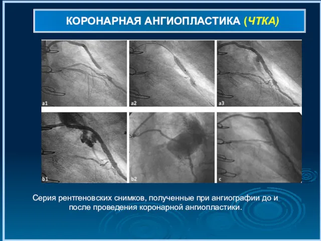 КОРОНАРНАЯ АНГИОПЛАСТИКА (ЧТКА) Серия рентгеновских снимков, полученные при ангиографии до и после проведения коронарной ангиопластики.