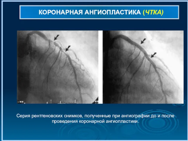 КОРОНАРНАЯ АНГИОПЛАСТИКА (ЧТКА) Серия рентгеновских снимков, полученные при ангиографии до и после проведения коронарной ангиопластики.