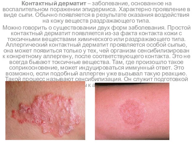 Контактный дерматит – заболевание, основанное на воспалительном поражении эпидермиса. Характерно проявление в виде