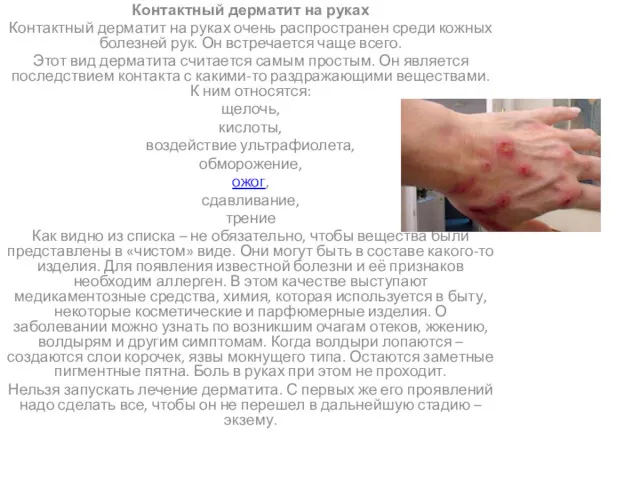 Контактный дерматит на руках Контактный дерматит на руках очень распространен среди кожных болезней
