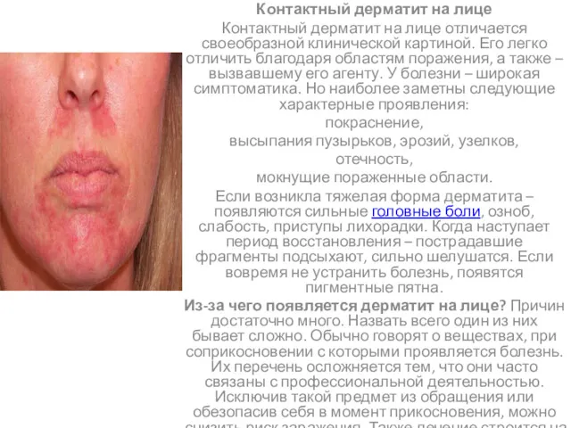 Контактный дерматит на лице Контактный дерматит на лице отличается своеобразной клинической картиной. Его