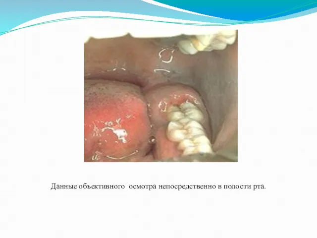 Данные объективного осмотра непосредственно в полости рта.