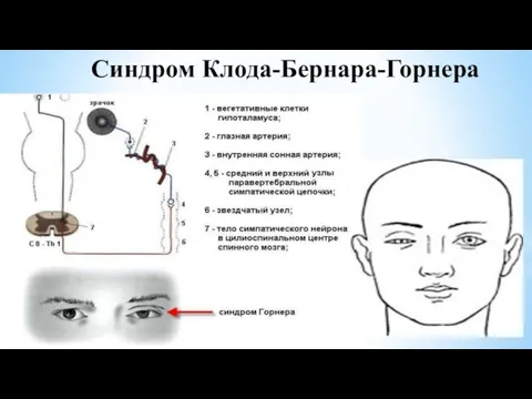 Синдром Клода-Бернара-Горнера Синдром Клода-Бернара-Горнера