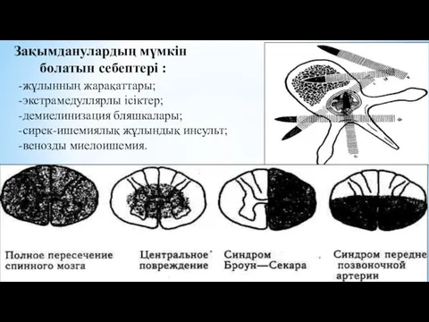 -жұлынның жарақаттары; -экстрамедуллярлы ісіктер; -демиелинизация бляшкалары; -сирек-ишемиялық жұлындық инсульт; -венозды миелоишемия. Зақымданулардың мүмкін болатын себептері :