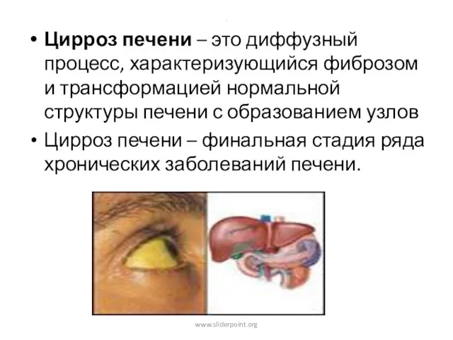 . Цирроз печени – это диффузный процесс, характеризующийся фиброзом и