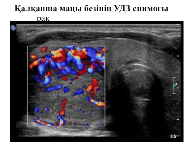 Қалқанша маңы безінің УДЗ снимогы рак