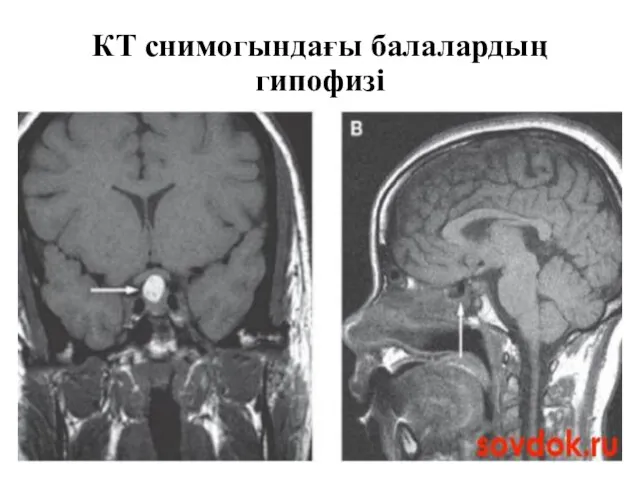 КТ снимогындағы балалардың гипофизі