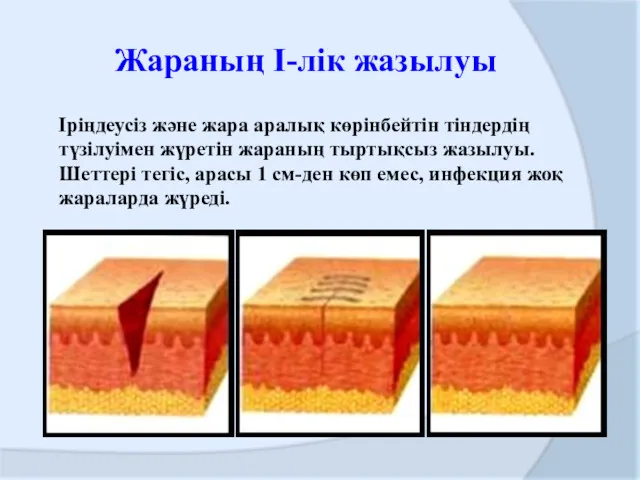 Жараның І-лік жазылуы Іріңдеусіз және жара аралық көрінбейтін тіндердің түзілуімен жүретін жараның тыртықсыз