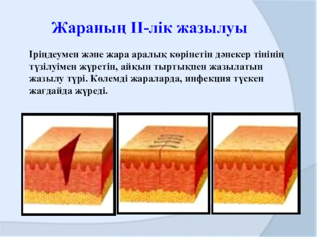 Жараның ІІ-лік жазылуы Іріңдеумен және жара аралық көрінетін дәнекер тінінің