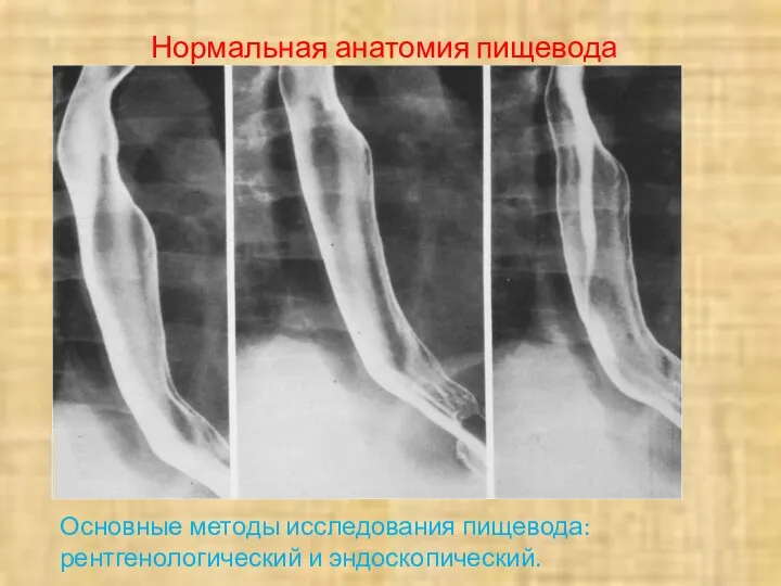 Нормальная анатомия пищевода Основные методы исследования пищевода: рентгенологический и эндоскопический.