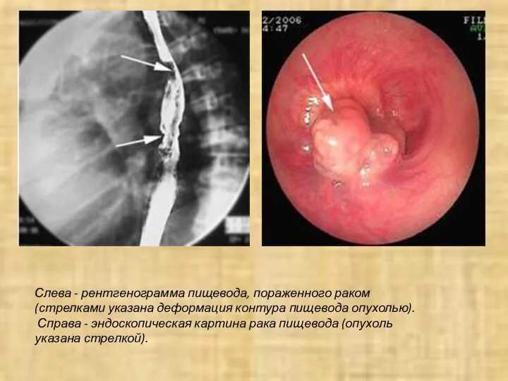 Слева - рентгенограмма пищевода, пораженного раком (стрелками указана деформация контура