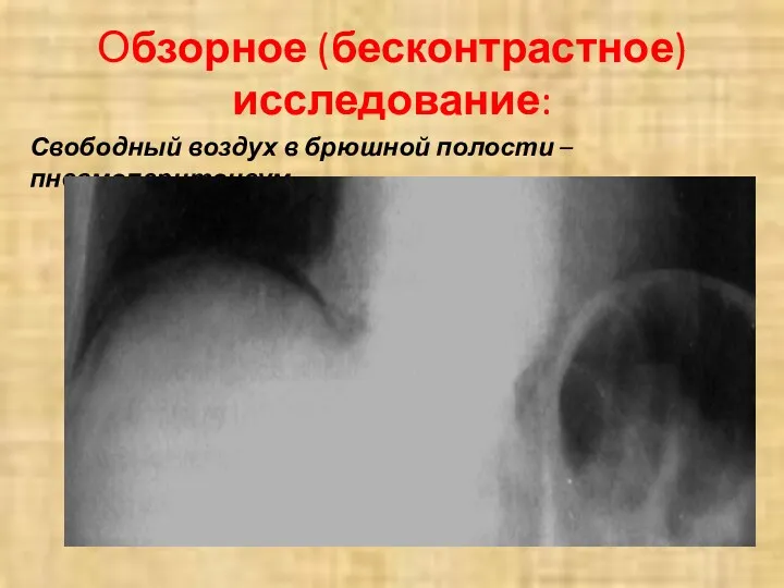 Обзорное (бесконтрастное) исследование: Свободный воздух в брюшной полости – пневмоперитонеум