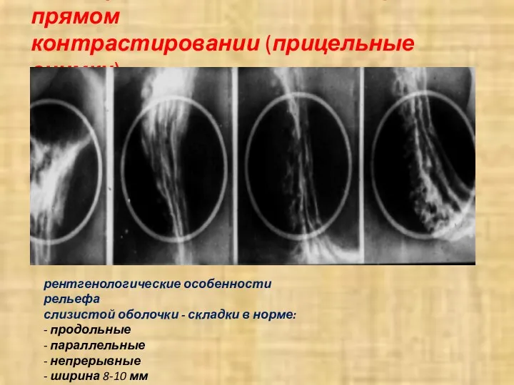 Рельеф слизистой оболочки при прямом контрастировании (прицельные снимки) рентгенологические особенности