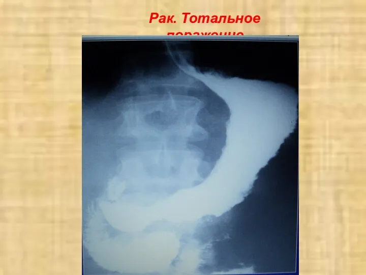 Рак. Тотальное поражение
