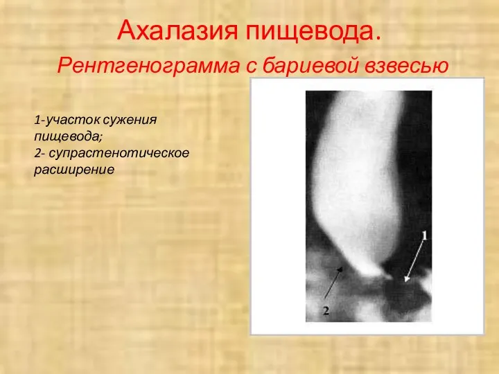 Ахалазия пищевода. Рентгенограмма с бариевой взвесью 1-участок сужения пищевода; 2- супрастенотическое расширение