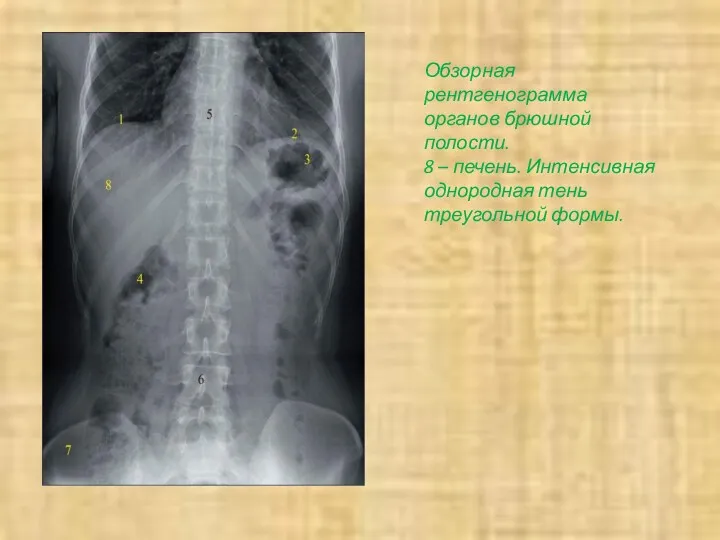 Обзорная рентгенограмма органов брюшной полости. 8 – печень. Интенсивная однородная тень треугольной формы.