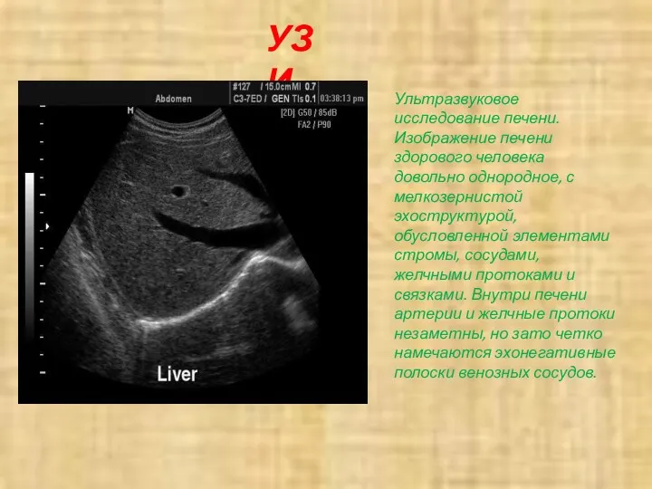 УЗИ Ультразвуковое исследование печени. Изображение печени здорового человека довольно однородное,
