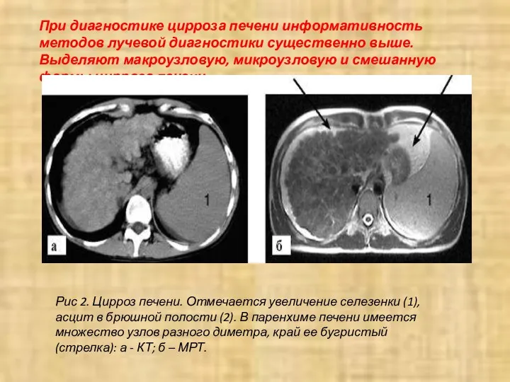 При диагностике цирроза печени информативность методов лучевой диагностики существенно выше.