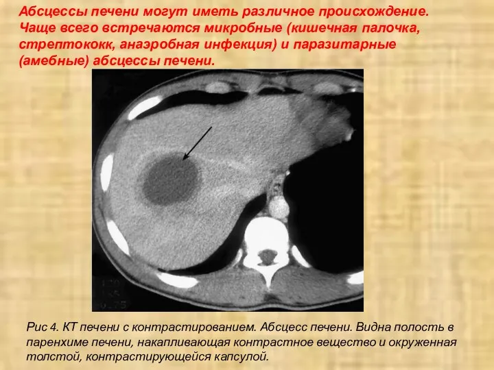 Абсцессы печени могут иметь различное происхождение. Чаще всего встречаются микробные