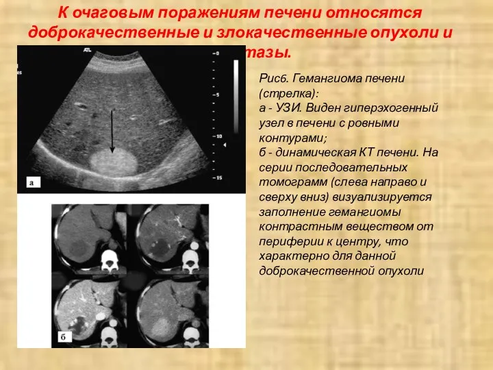 К очаговым поражениям печени относятся доброкачественные и злокачественные опухоли и