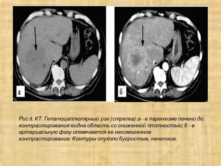 Рис 8. КТ. Гепатоцеллюлярный рак (стрелка):а - в паренхиме печени