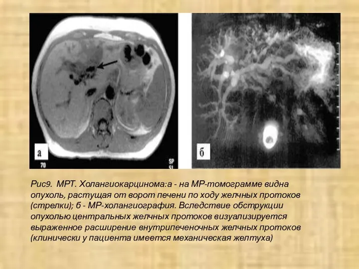 Рис9. МРТ. Холангиокарцинома:а - на МР-томограмме видна опухоль, растущая от