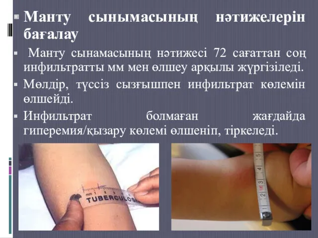 Манту сынымасының нәтижелерін бағалау Манту сынамасының нәтижесі 72 сағаттан соң