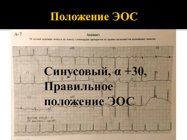 Положение ЭОС Синусовый, α +30, Правильное положение ЭОС