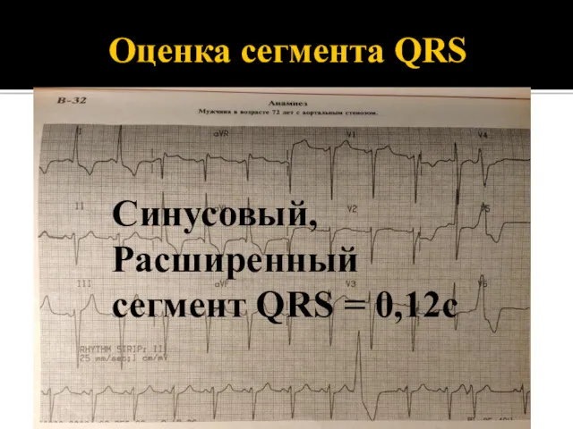 Оценка сегмента QRS Синусовый, Расширенный сегмент QRS = 0,12с