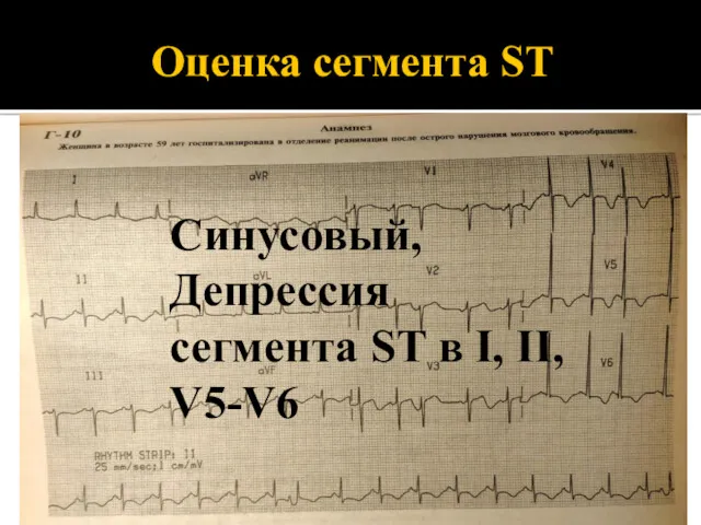 Оценка сегмента ST Синусовый, Депрессия сегмента ST в I, II, V5-V6