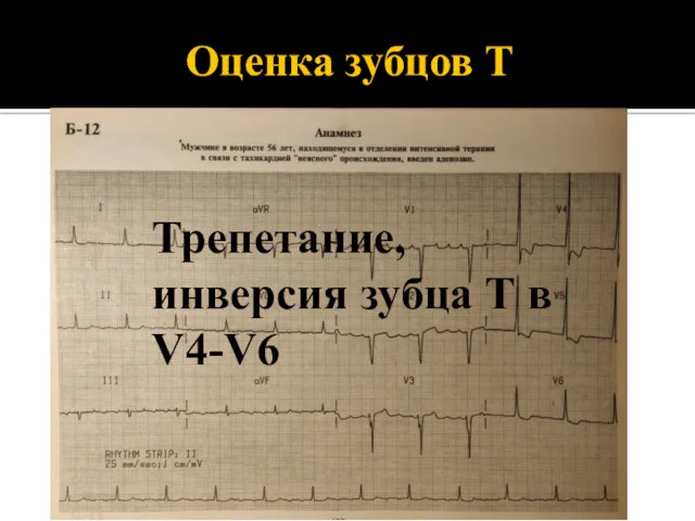 Оценка зубцов Т Трепетание, инверсия зубца Т в V4-V6