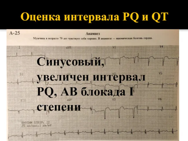 Оценка интервала PQ и QT Синусовый, увеличен интервал PQ, АВ блокада I степени