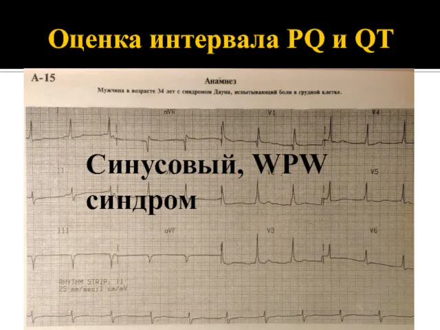 Оценка интервала PQ и QT Синусовый, WPW синдром