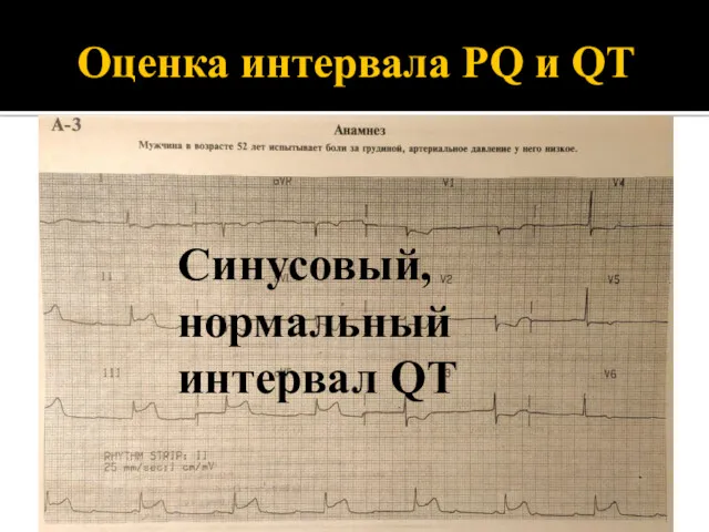 Оценка интервала PQ и QT Синусовый, нормальный интервал QT