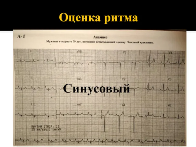 Оценка ритма Синусовый