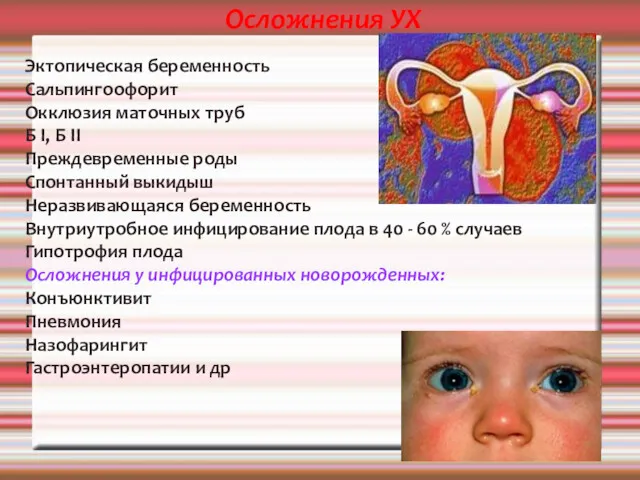 Осложнения УХ Эктопическая беременность Сальпингоофорит Окклюзия маточных труб Б I,