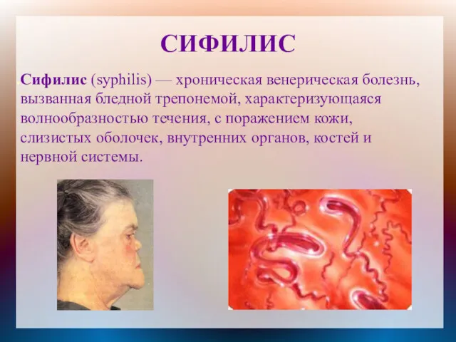 СИФИЛИС Сифилис (syphilis) — хроническая венерическая болезнь, вызванная бледной трепонемой,