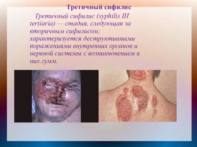 Третичный сифилис Третичный сифилис (syphilis III tertiaria) — стадия, следующая