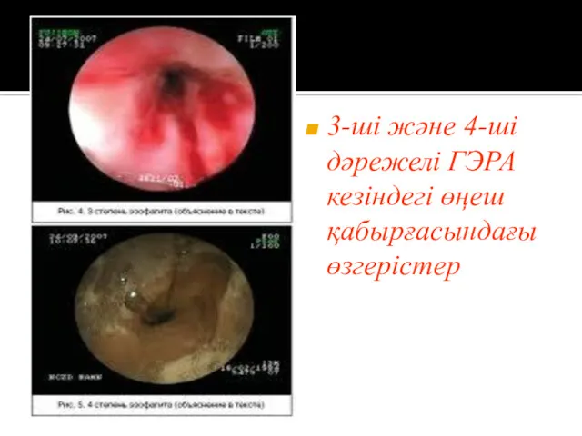 3-ші және 4-ші дәрежелі ГЭРА кезіндегі өңеш қабырғасындағы өзгерістер