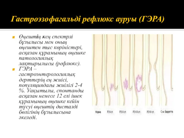 Гастроэзофагальді рефлюкс ауруы (ГЭРА) Өңештің кең спектрлі бұзылысы мен оның