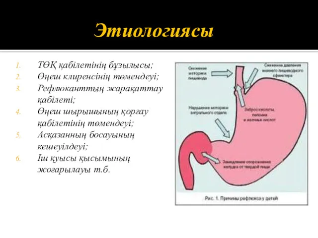 Этиологиясы ТӨҚ қабілетінің бұзылысы; Өңеш клиренсінің төмендеуі; Рефлюканттың жарақаттау қабілеті;