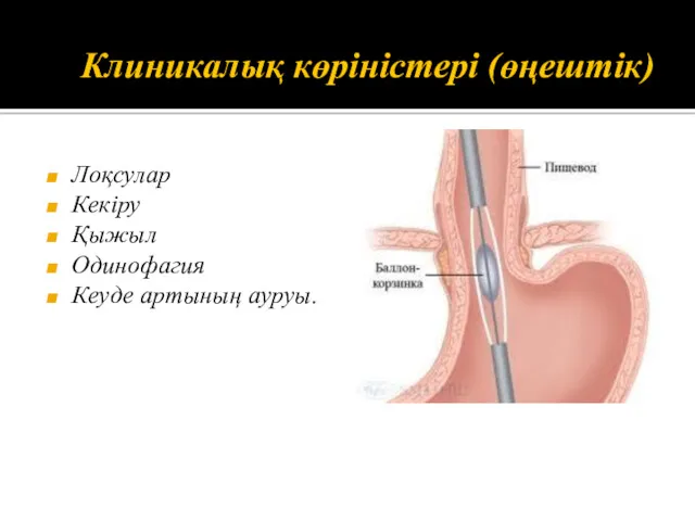 Клиникалық көріністері (өңештік) Лоқсулар Кекіру Қыжыл Одинофагия Кеуде артының ауруы.