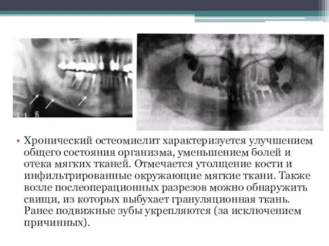 Хронический остеомиелит характеризуется улучшением общего состояния организма, уменьшением болей и