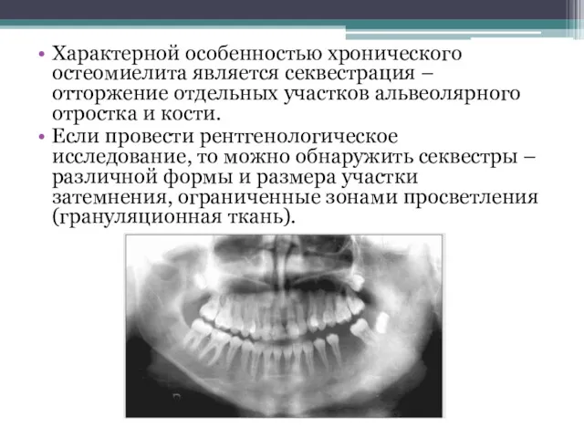 Характерной особенностью хронического остеомиелита является секвестрация – отторжение отдельных участков