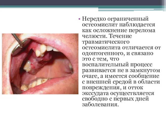 Нередко ограниченный остеомиелит наблюдается как осложнение перелома челюсти. Течение травматического