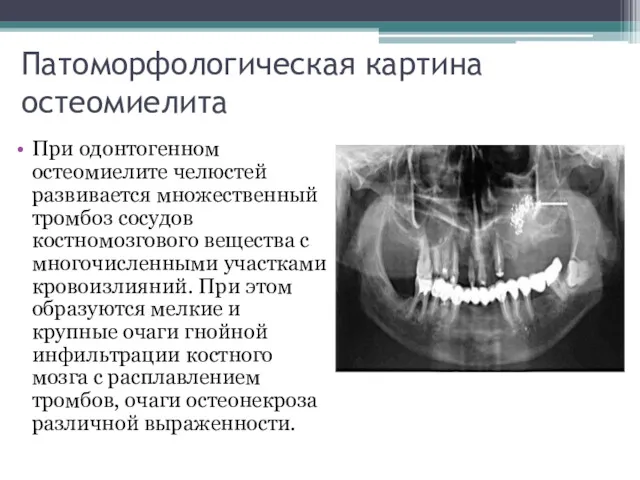 Патоморфологическая картина остеомиелита При одонтогенном остеомиелите челюстей развивается множественный тромбоз