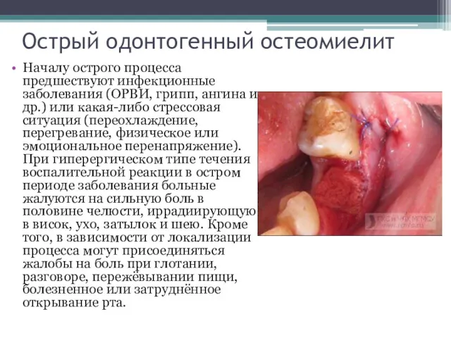 Острый одонтогенный остеомиелит Началу острого процесса предшествуют инфекционные заболевания (ОРВИ,
